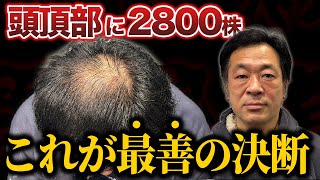 【初登場】20年間も頭頂部の薄さに悩む40代男性の葛藤と決断