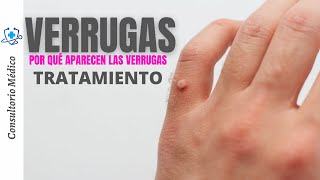 VERRUGAS | ¿Por qué aparecen las verrugas? Tratamientos | 👨‍⚕️ Consultorio Médico