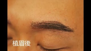 植眉經驗談│ 植眉失敗尋求植眉矯正2 │林宜蓉醫師 Dr.Yi Jung Lin