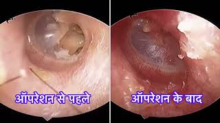 कान के पर्दे के छेद का सफल ऑपरेशन  | पहले व बाद का वीडियो। Myringoplasty