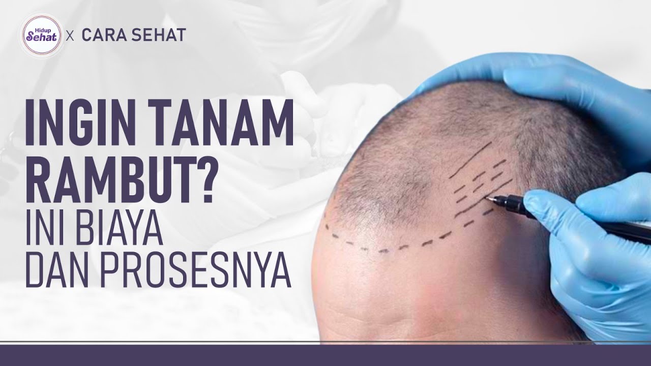 Syarat, Proses Dan Biaya Tanam Rambut (Transplantasi Rambut) | Hidup ...