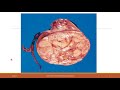 Wilms tumor-Dr MB