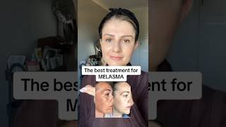 The best treatment for melasma! #skincare #skinadvice #skincaretips #hyperpigmentationtreatment