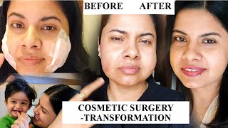 My Cosmetic Surgery details | Decisions ka Consequences | Acne scar solution