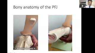 September 2020: Patellar Instability: Surgical and Conservative Management Options