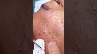 Huge Blackhead Extraction: Extremely Satisfying!