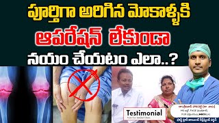 పూర్తిగా అరిగిన మోకాళ్ళకి ఆపరేషన్ లేకుండా నయం చేయటం ఎలా | Treating Knee Arthritis Without Surgery