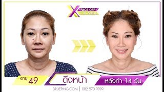 ดึงหน้าเฟซออฟ : ปรับความสาว เพิ่มความสวย ด้วยฝีมือศัลยแพทย์ตกแต่งไทย