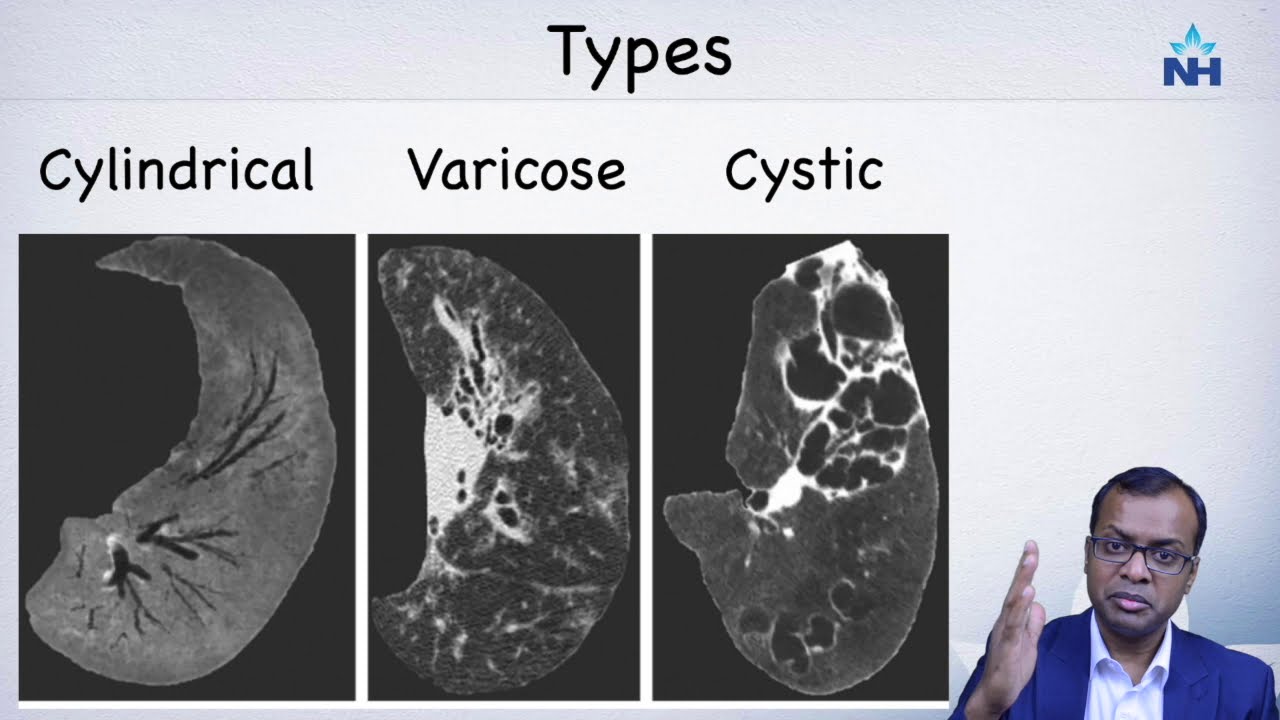 CT Imaging And Diagnosis Of Bronchiectasis - YouTube