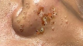 Up-Close Blackhead Extraction – So Satisfying to Watch! #33751