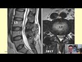 a case of double failed lumbar fusion and dangerously misplaced pedicle screws