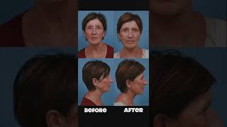 3 Weeks Facelift Testimonial | Deep Plane Facelift  #facialplasticsurgery