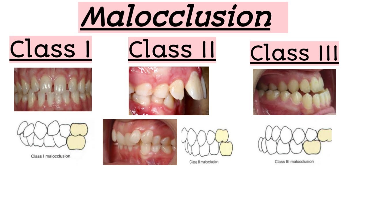 Class 3 Malocclusion