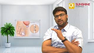 Dr. Y. Ajit Vikram, Consultant Urologist & Andrologist talk about Myths and Facts about Vasectomy
