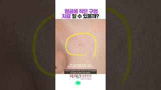 얼굴에 생긴 작은 구멍 제거! 부산위너홀 #위너확장구멍