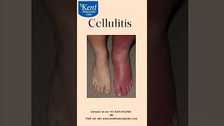 Cellulitis -Best homeopathy treatment Drkukreja kalani online consultation 8291492566