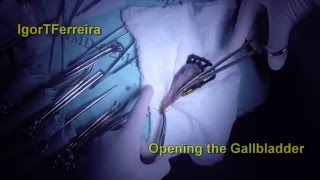 Gallbladder Polyps - Full HD - GoPro Footage