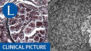 Immunotactoid glomerulopathy associated with monoclonal gammopathy