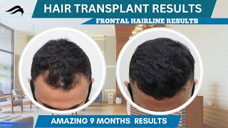 Hair Transplant In Tumkur | Best Results Cost Center \u0026 surgeon Of Hair Transplant In Tumkur