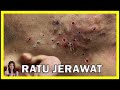 Cara Mengatasi Jerawat Hormonal