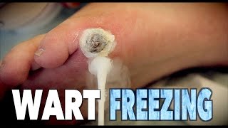 GIANT WART FREEZING (with liquid nitrogen) | Dr. Paul