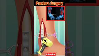 Fracture Surgery | leg fracture | #shorts #medical #viral #fracture