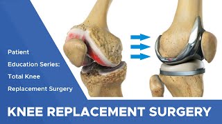 Patient Education Series: Total Knee Replacement Surgery