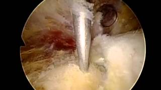 Shoulder Arthroscopy with Rotator Cuff Repair