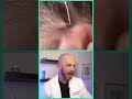 Doctor reacts to impacted ingrown hair removal! #dermreacts #doctorreacts #ingrownhair