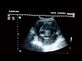 hydrops fetalis ultrasound