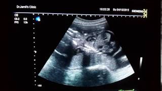 Hydrops Fetalis ultrasound