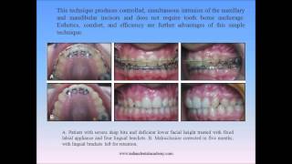 lingual brackets / orthodontic courses by Indian dental academy