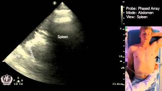 Abdominal Ultrasound of the Spleen (Basic )