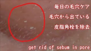 閲覧注意（開いた毛穴ケア）get rid of sebum 角栓除去 whitehead #keratin plug #blackheads #痘痘 #粉瘤 #角栓 #皮脂 #cravos