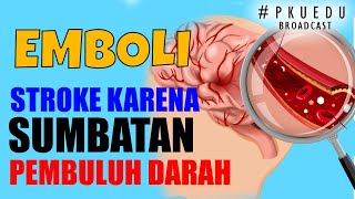 Mengapa Stroke Emboli Bisa Terjadi pada Siapa Saja ? | #PKUEDU