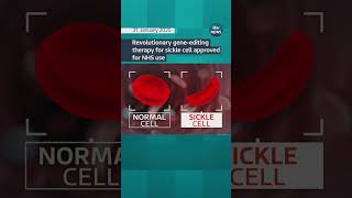 Revolutionary gene-editing therapy for sickle cell approved for use on NHS.