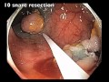 Trans colon -  Large Sessile polyp - EMR and Clip closure