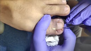 镶甲 paronychia ingrown toenailingrown nail treatment 90