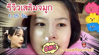 รีวิวการเสริมจมูก 1-15 วันเป็นยังไง?? #เสริมจมูก #รีวิวเสริมจมูก