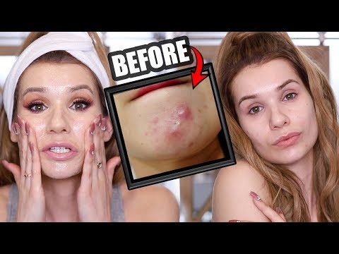 HOW TO INSTANTLY GET RID OF ACNE OVERNIGHT (ACTUALLY WORKS!) HOW TO INSTANTLY GET RID OF ACNE OVERNIGHT (ACTUALLY WORKS!)