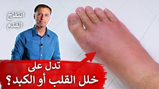 مكان احتباس السوائل قد يدل على خلل في القلب أو الكبد | وذمة وانتفاخ القدم اليمنى