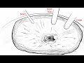 LAPAROSCOPIC-ASSISTED TRANSGASTRIC RESECTION OF GASTRIC GIST NEAR GASTROESOPHAGEAL JUNCTION