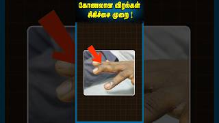 கோணலான விரல் சிகிச்சை முறை|Mallet Finger Deformity|Finger correction surgery|Finger Cut injury