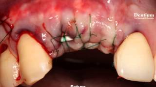 GBR on upper Anterior. Esthetic area