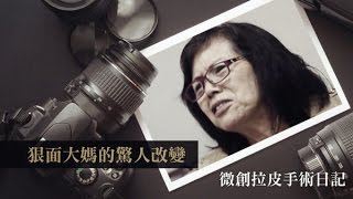 【整形影片拍攝製作】狠面大媽微創拉皮手術日記 術後30天完整紀錄