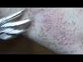 eczema asmr the sound of scratching itchy shins with a metal grandson s hand massage