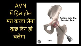 आपको AVN का प्रॉब्लम आया है क्या ? आपको THR बताया  गया है क्या ?