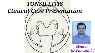 TONSILLITIS Clinical Case Presentation