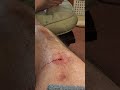 draining infected knee day 1