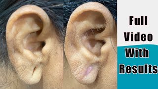 Ear Lobe / Ear Hole /Ear Pasting Glue / Ear Pasting Lotion / Ear Lobe Repairing With Out Stiches